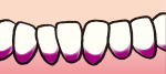 歯と歯ぐきの間