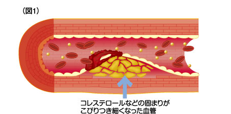 どうして「動脈硬化」になるの?